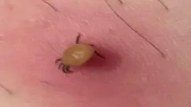Kene ısırığı belirtisiz başlar, hızla ağırlaşabilir